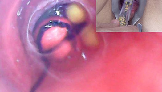 Wanita dewasa, kamera endoskopi lubang intip di kandung kemih dengan bola