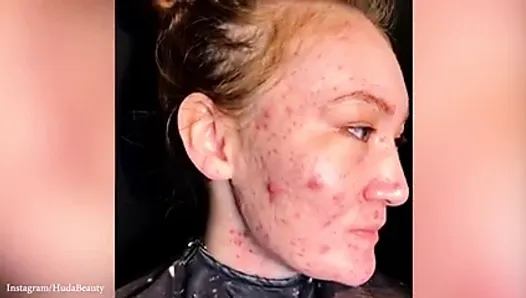 adult acne age